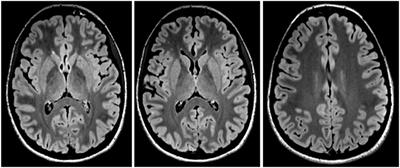 Psychiatric Presentation of Anti-NMDA Receptor Encephalitis